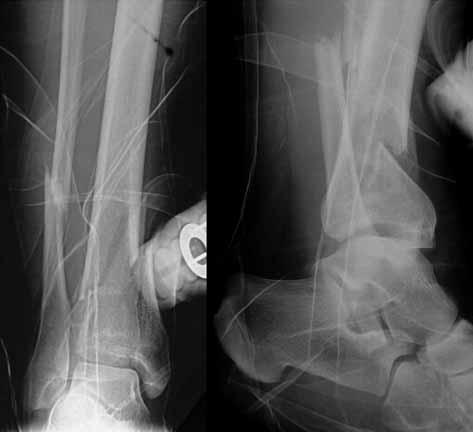PERCUTANEOUS PLATING OF THE DISTAL TIBIA 151 Figs. 3 &.