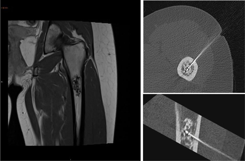 Fig. 1 a Representative MRI of an atypical cartilaginous tumour (ACT) in the proximal femur.