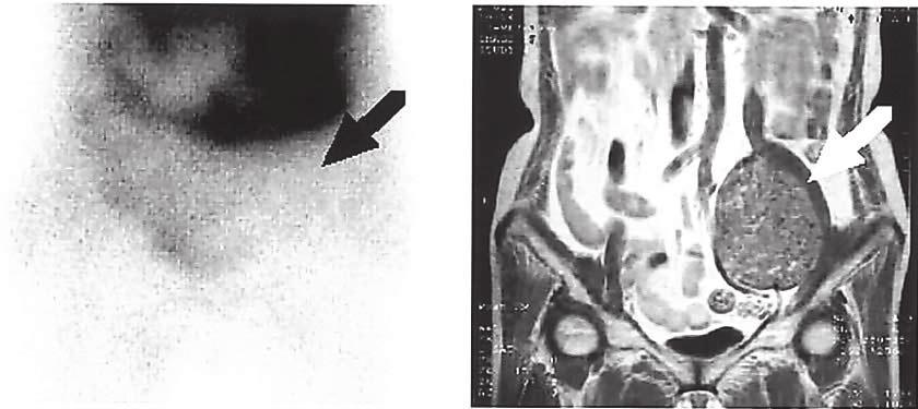 MATERIALS AND METHODS Patients Twenty-two patients presenting with bone and soft tissue tumors, who underwent 201 Tl scintigraphy and whose lesions were subsequently shown to be cartilaginous tumors
