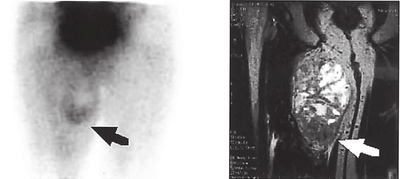 A B Fig. 2 Planar 201 Tl (A) and coronal T2-weighted magnetic resonance (B) images of a patient presenting with mesenchymal chondrosarcoma of the thigh (patient number 21).