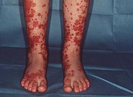 Henoch-Schonlein Purpura (HSP) IgA mediated leucocytoclastic vasculitis Most common small vessel vasculitis in children Usually preceded by URI or Strep infection Age: 2-13 years old Usually self