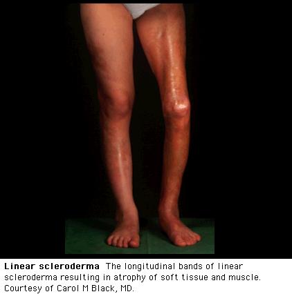 Scleroderma Scleroderma Systemic Localized Multisystemic Disease