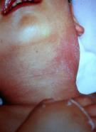 Kawasaki disease AKA Mucucutaneous Lymph Node Syndrome Definition: Self limiting Medium Size