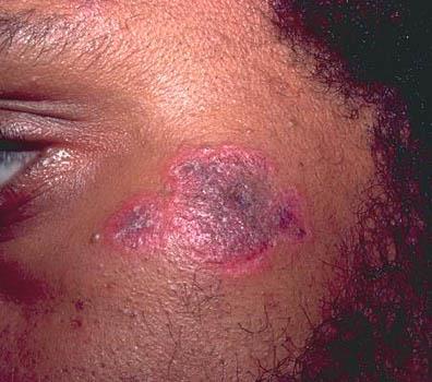 SLE Criteria 4/11 4 Skin Malar Rash Discoid Rash Photosensitivity