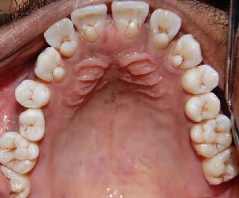 Alterations in crown shape Accessory lingual ridges permanent maxillary incisors : esp.