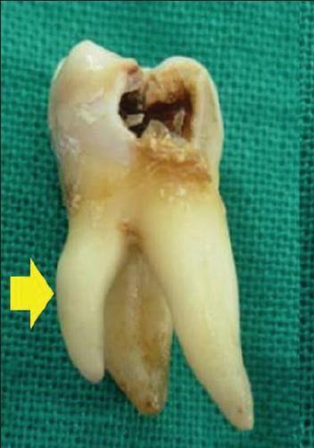 roots) third molars,