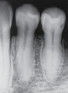 premolars & molars
