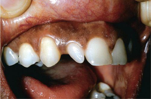 Developmental alterations in size of teeth Race, systemic disease, syndromes,etc.