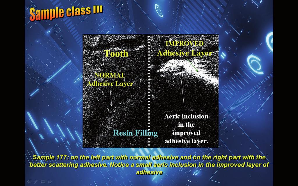 7, left side), which is difficult to evaluate (the black area could be aeric inclusions, transparent adhesive layer or both), and the second interface with improved scattering adhesive (Fig.