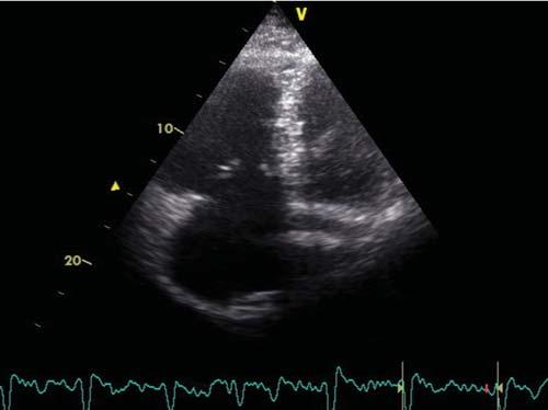 Figure 3. Transthoracic echocardiographic B-mode image in apical view showing moderately dilated right ventricle.