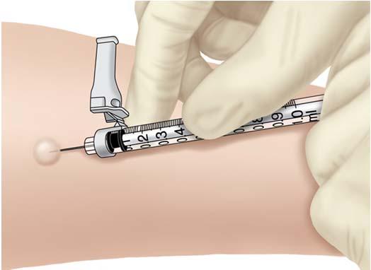 Mantoux Tuberculin Skin Test Continuously in use for over 100 years in clinical medicine Skin test that measures delayed-type hypersensitivity reaction to a