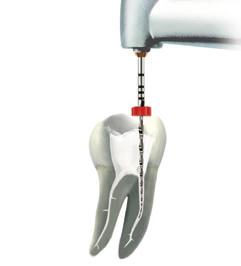 3. Preparation Step by Step Ensure you have achieved a straight line access to the root canal entrance. 3x 1.