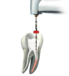 4. Retreatment with Step by Step Retreatment of gutta-percha and carrier-based fillings 1. Removal of gutta-percha in the coronal third e. g. with a Gates Glidden drill, an ultrasonic instrument such as VDW.