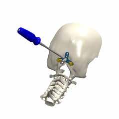 23. Select the most suitable design of Occipital plate to implant. Contour it with the dedicated instrument. Position the Occipital plate over the occiput.