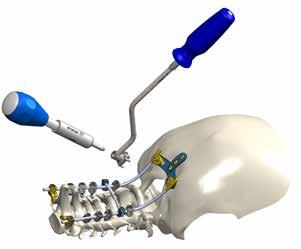 4 ROD COUNTURING AND INSERTION Use the malleable rod template to determine the rod curvature between the occiput and the upper cervical vertebrae and to