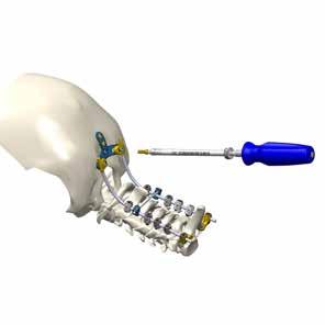 occipital rod remover. 59.