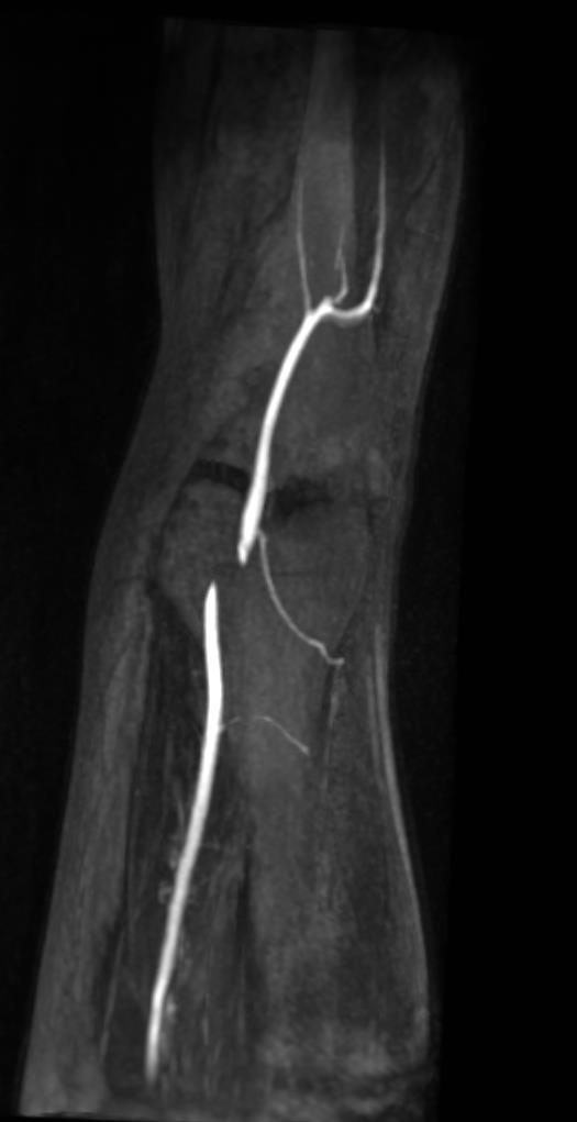 15 year-old man with a disabling left calf claudication.