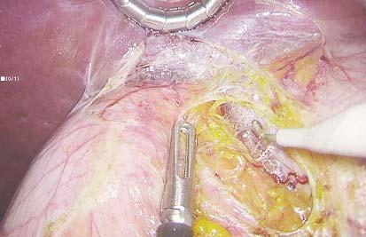 Figure 3. Dissection of the right borded of the inferior vena cava the limits of the operating field.