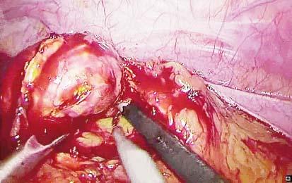 to open surgery and since most adrenal tumors are benign, partial resections should be taken into