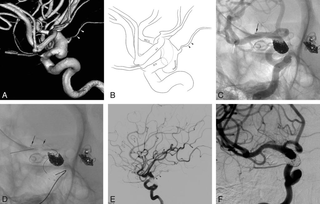 Fig 3. A 30-year-old woman with a postclip recurrent aneurysm in the left posterior communicating artery, left anterior choroidal artery, and right anterior choroidal artery.