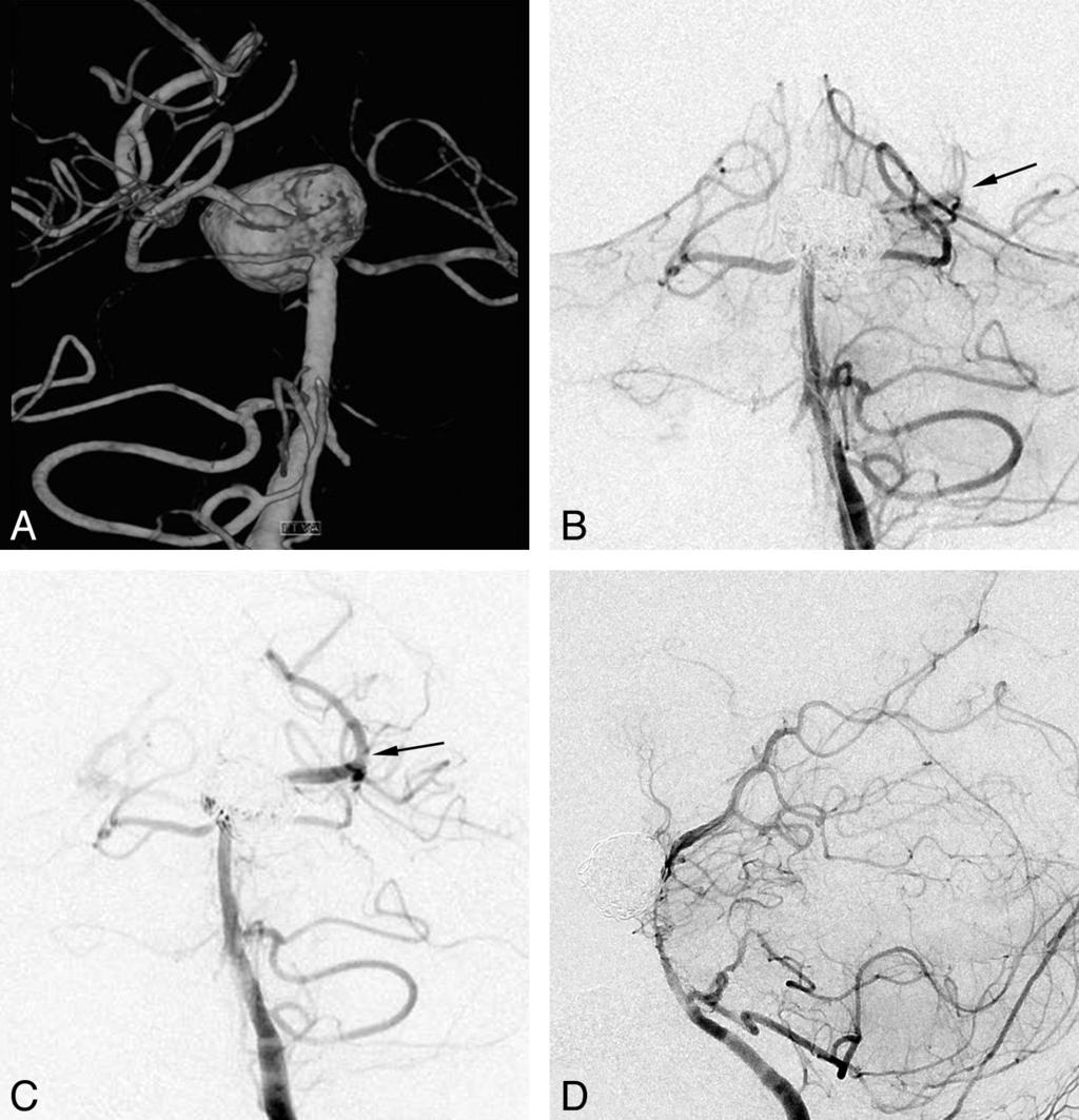 Fig 4. A 45-year-old man with an unruptured large aneurysm at the basilar artery tip.
