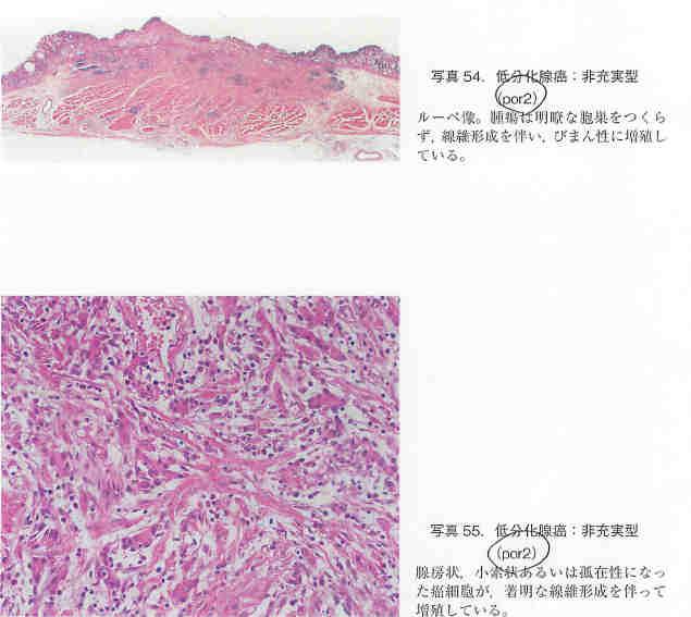 JGCA, Japanese Gastric Cancer