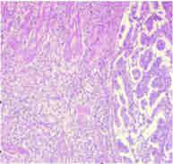 Histological classifications of gastric cancer Laurén (1965) Nakamura (1968) JGCA (2017) Intestinal Differentiated Papillary: pap Tubular 1, well-differentiated: tub1 Tubular 2,