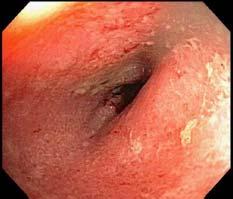 Ulcerative Colitis Patients (%) Erythema Mild loss of vasculature Mild edema, granularity Mild friability