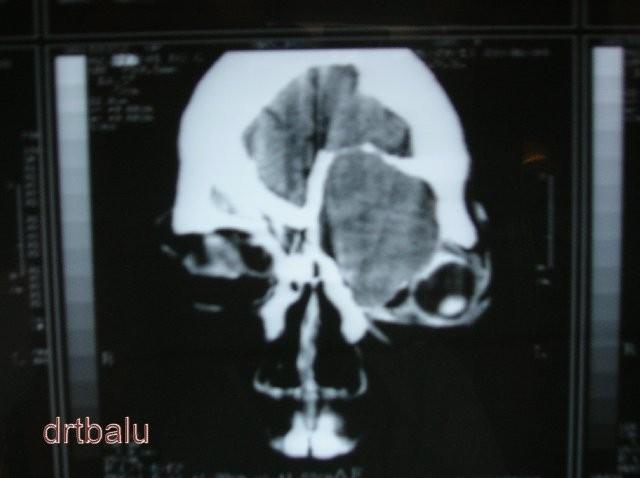 CT scan coronal