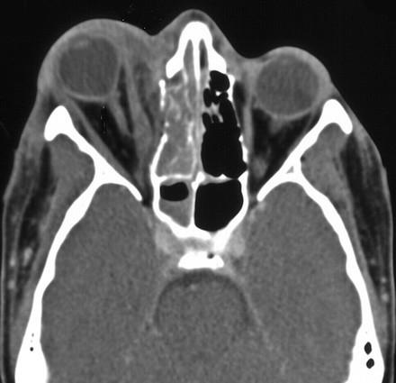 Axial CT showing ethmoidal lesion involving the orbit CT scan showing fibrous dysplasia of