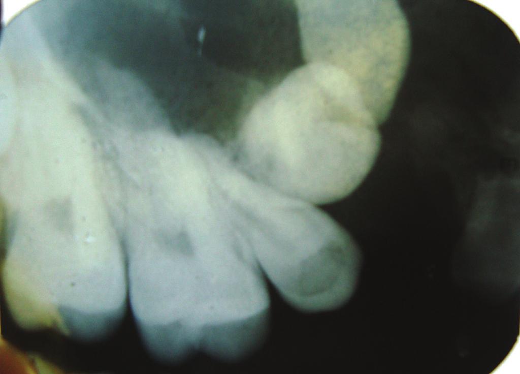 Patient was further subjected to radiographic investigation where intraoral periapical radiograph (Figure 2), occlusal maxillary cross-sectional (Figure 3), and panoramic radiograph (Figure 4) were
