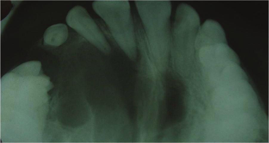 Occlusal radiograph showed ill-defined radiolucency with intermittent septa involving the entire right maxilla and crossing the midline.