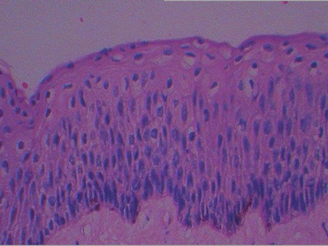 Case Reports in Dentistry 3 (a) (b) Figure 6: Photomicrograph of the histopathological slide.