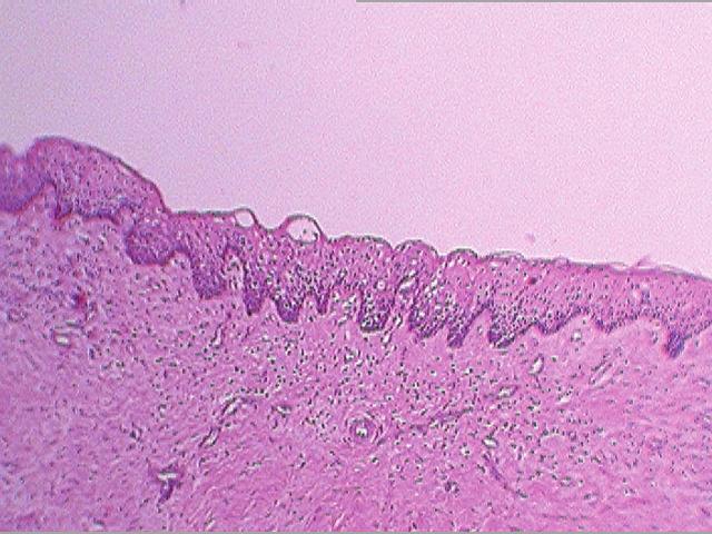 odontogenic keratocyst of the jaws, basal cell carcinoma (BCC) of the skin, and vertebral anomalies [7].