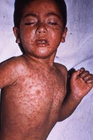 Measles Maculopapular rash Starts in the