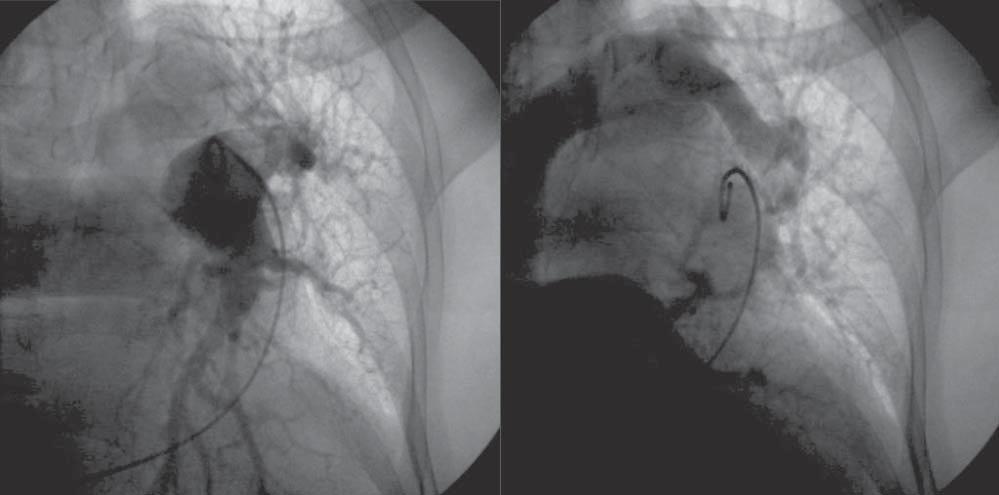 Pulmonary angiography. Left: injection of contrast into the left pulmonary artery.