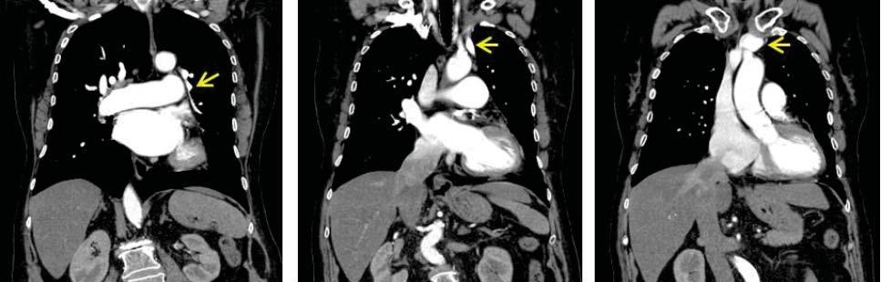 Figure 8. CT pulmonary angiography, venous phase, coronal sections. Tracking of abnormal left pulmonary upper lobe drainage into the left brachiocephalic vein (yellow arrows).