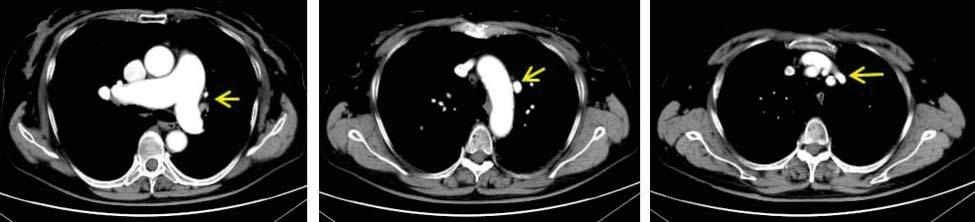 In the absence of a clear etiology to explain the PAH and its accompanying symptoms, right heart catheterization (RHC) was performed this confi rmed the PHT, with a mean PAP of 28 mmhg, and with a