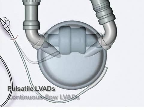 LVAD Function