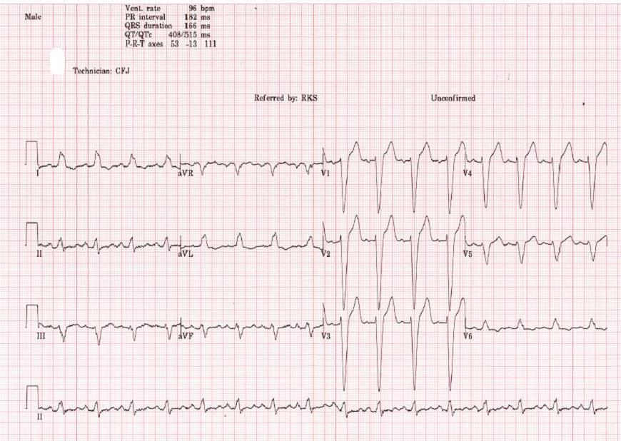 ECG in heart failure Heart rate Heart rhythm Old heart attacks