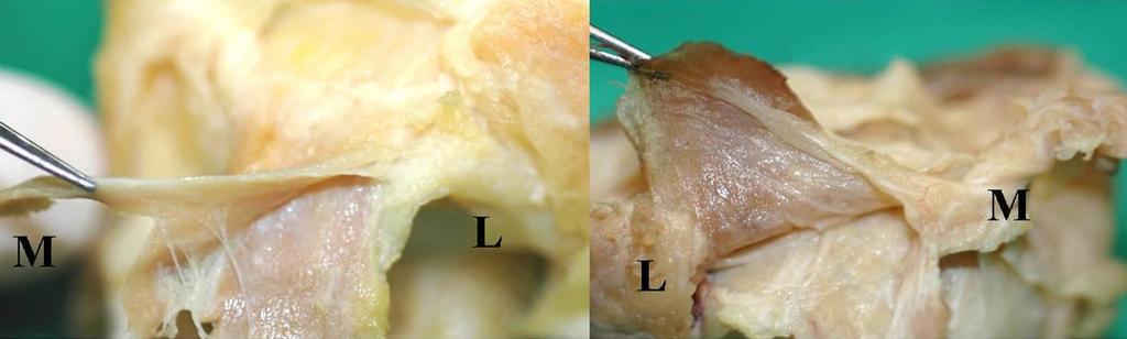 Photographs showing the medial attachment of the levator palpebrae superioris (upper side muscle)and the superior rectus muscle (lower side muscle) connected by a fibrous membrane (M: medial, L: