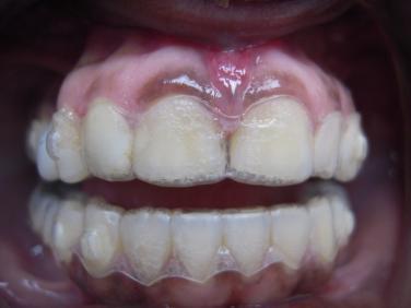 VIII. CROSSBITE CORRECTION COMMON PROBLEM: 1.Anterior or Posterior 2.Tracking is Excellent 3.Doesn t Match Clincheck 4.