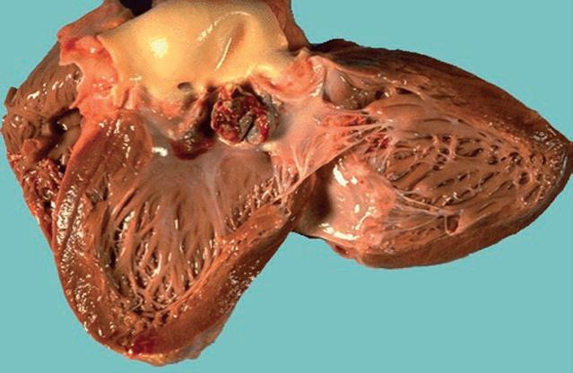 The aortic valve shows a large, irregular, reddish tan vegetation.