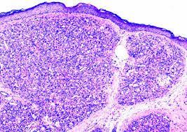 epidermis Lobular pattern of tumor growth Lobular capillary hemangioma (pyogenic granuloma).