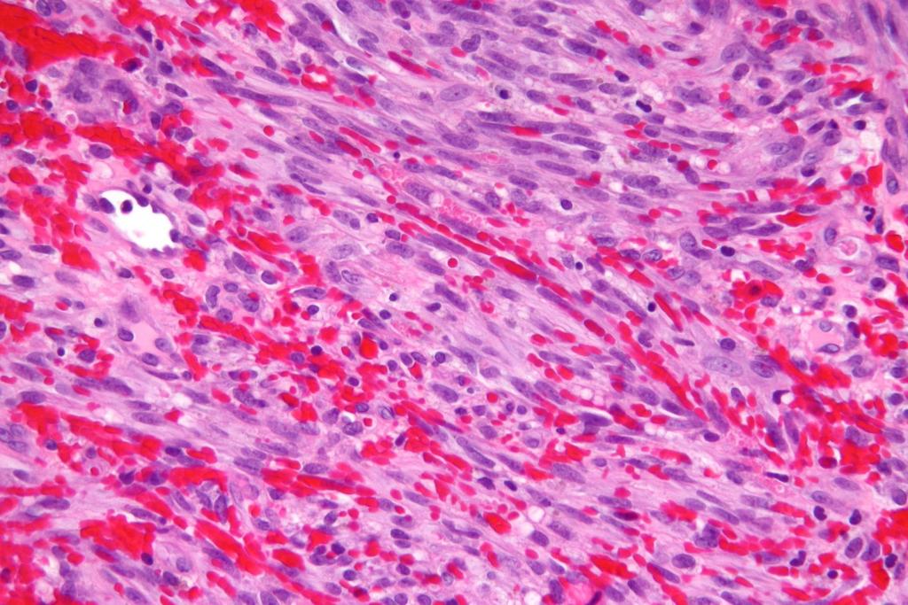 Kaposi sarcoma (intermediate behavior) Cellular tumor composed of spindle cells many mitoses may be seen moderate