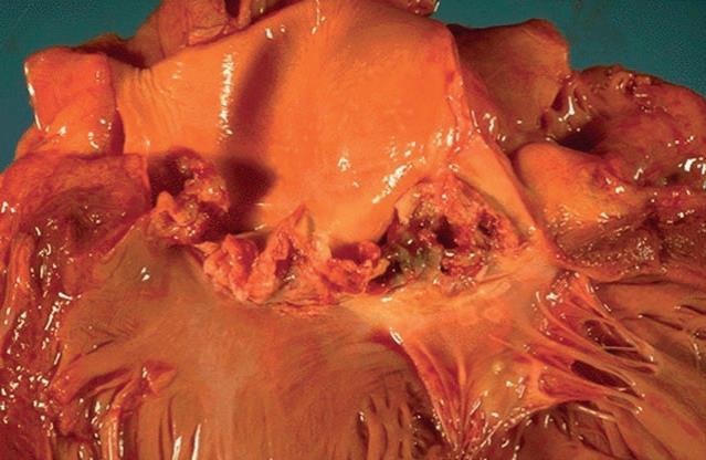 Acute bacterial form of infective endocarditis can lead to serious valvular destruction, as shown here involving the aortic valve.