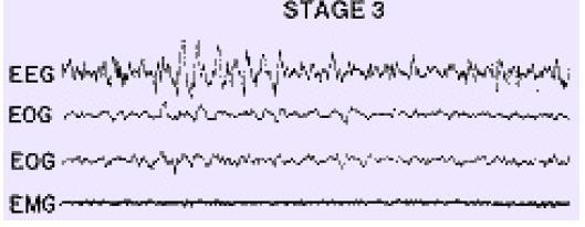 Stage 3 EEG delta waves, 0,5-2 Hz & amplitude >75mV; covering around 20-50% from