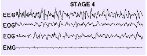 Stage 4 EEG delta activity covering >50% from the