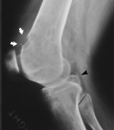 (b) Lateral radiograph shows multiple lytic lesions in the distal femur and patella. A subtle area of lucency is present in the posterior tibia (arrowhead).