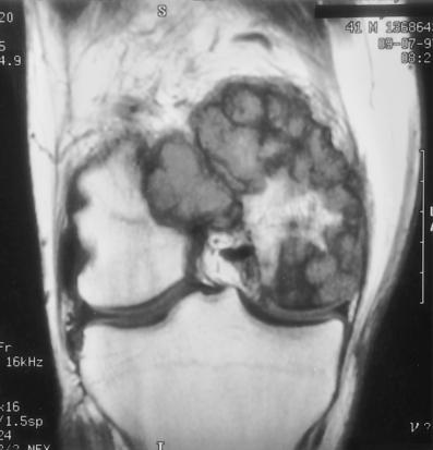 Coronal T1-weighted MR images (repetition time msec/echo time msec = 666/15) (a obtained anterior to b) show a nodular mass involving the medial femoral condyle,